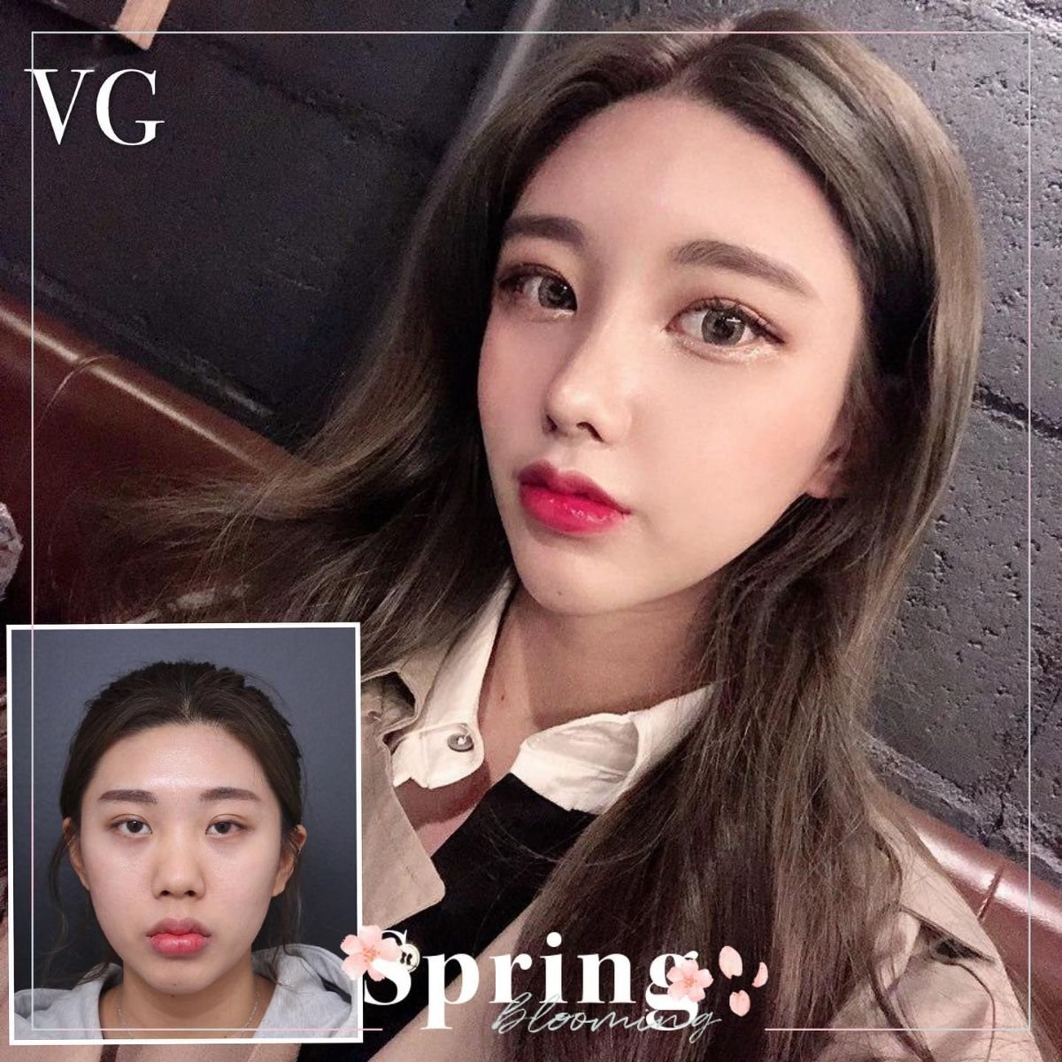 Resultados antes y después de rinoplastia asiática en VG Plastic Surgery – nariz refinada