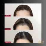 Before and after Hair transplant photos by Dr. Dr Phatcharasak Kraisornphongsakul Md