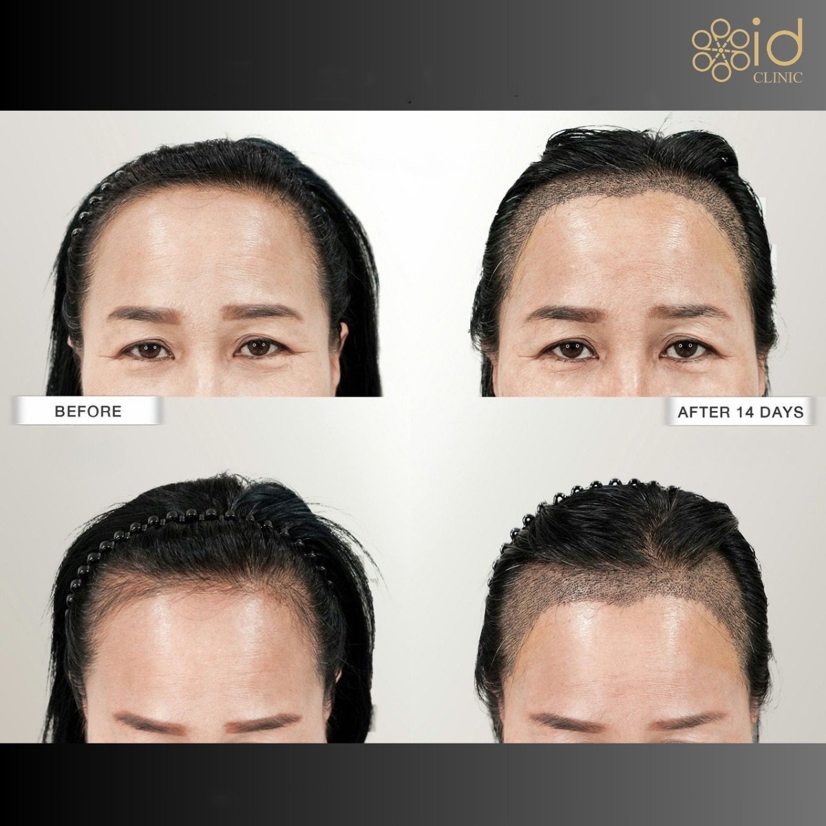 Before and after hair transplant results at ID Clinic Bangkok, visible hairline restoration