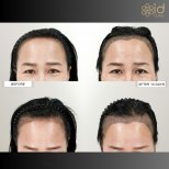 صور قبل وبعد زراعة الشعر للدكتور Dr Phatcharasak Kraisornphongsakul Md