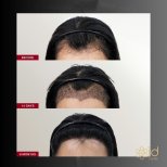 صور قبل وبعد زراعة الشعر للدكتور Dr Phatcharasak Kraisornphongsakul Md