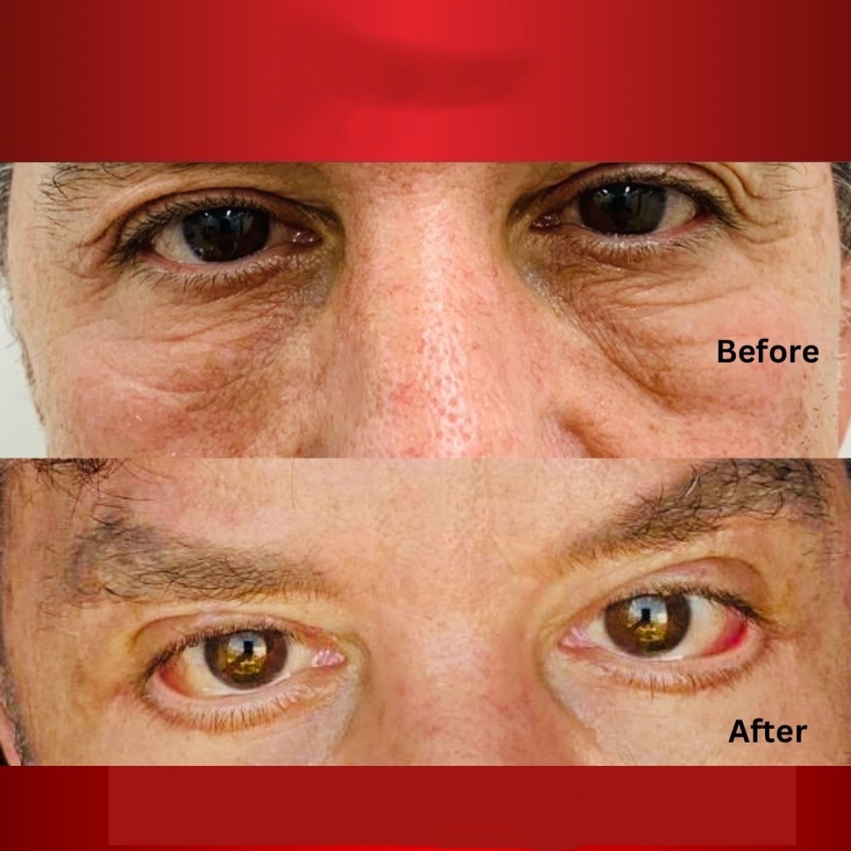 Resultados de blefaroplastia antes y después en DGB Clinic – párpados más lisos y sin bolsas