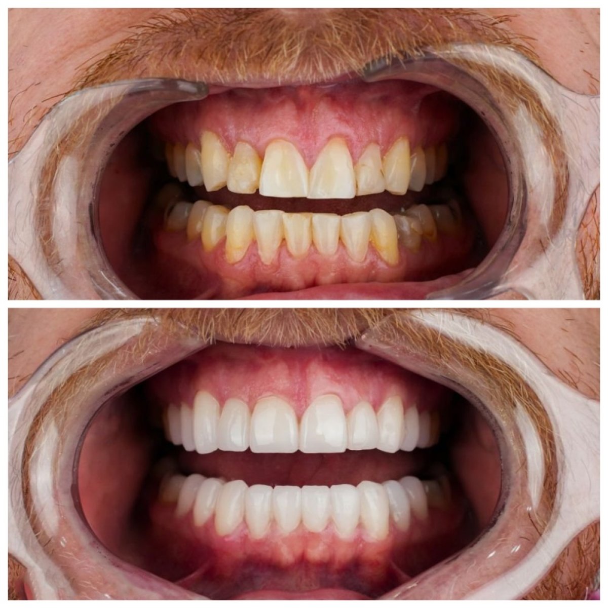Résultats avant/après Hollywood Smile chez Nifa Dent International – dents blanches et alignées