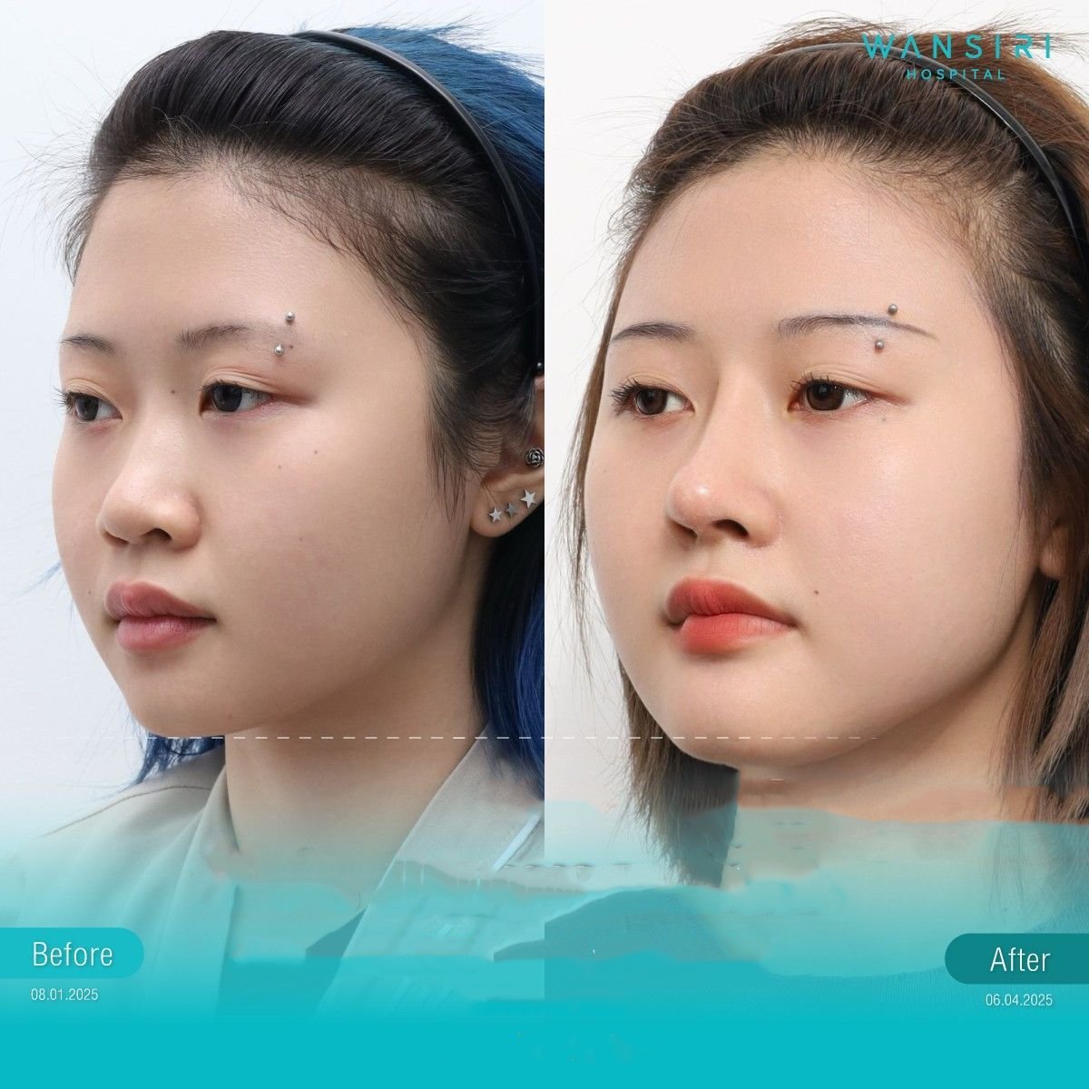 Before and after chin implant result at Wansiri Hospital, enhanced chin contour and profile