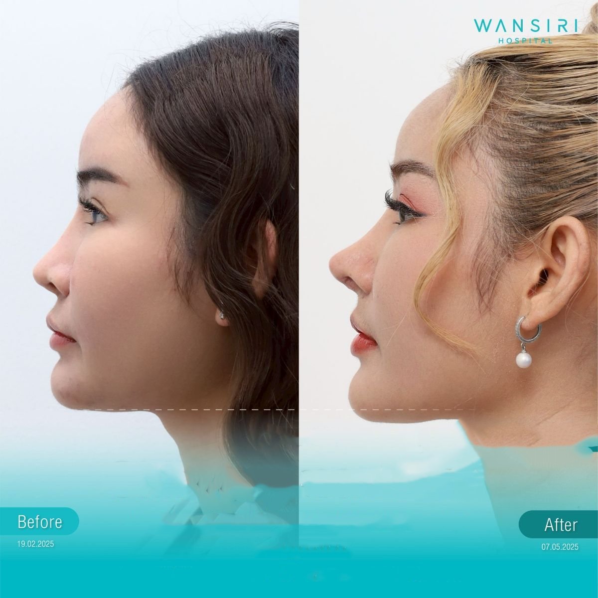 Before and after chin implant results at Wansiri Hospital, improved chin contour and profile