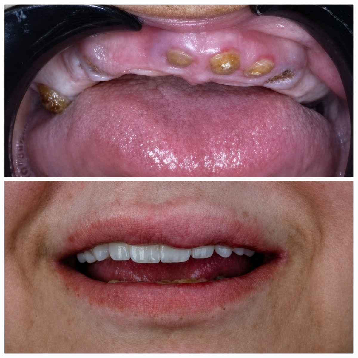 نتائج قبل وبعد تركيب طقم الأسنان في Omara Dental Centers – ابتسامة مستعادة