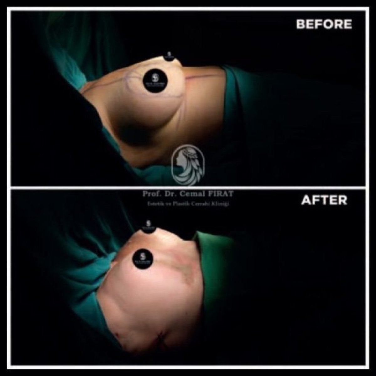 Resultados antes y después de reducción de senos en Medical Park Antalya Hospital Complex