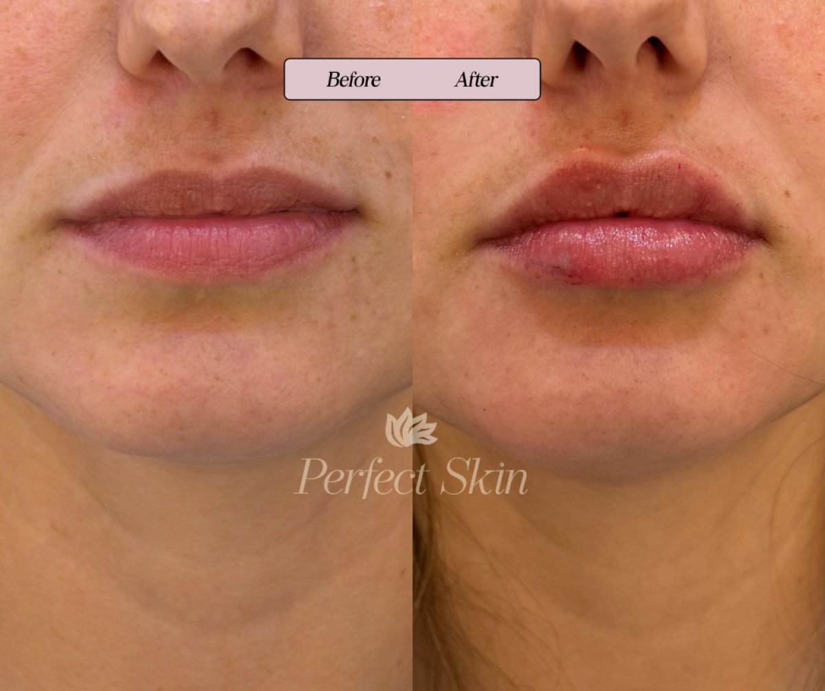 Efekt przed i po powiększaniu ust kwasem hialuronowym w klinice Perfect Skin