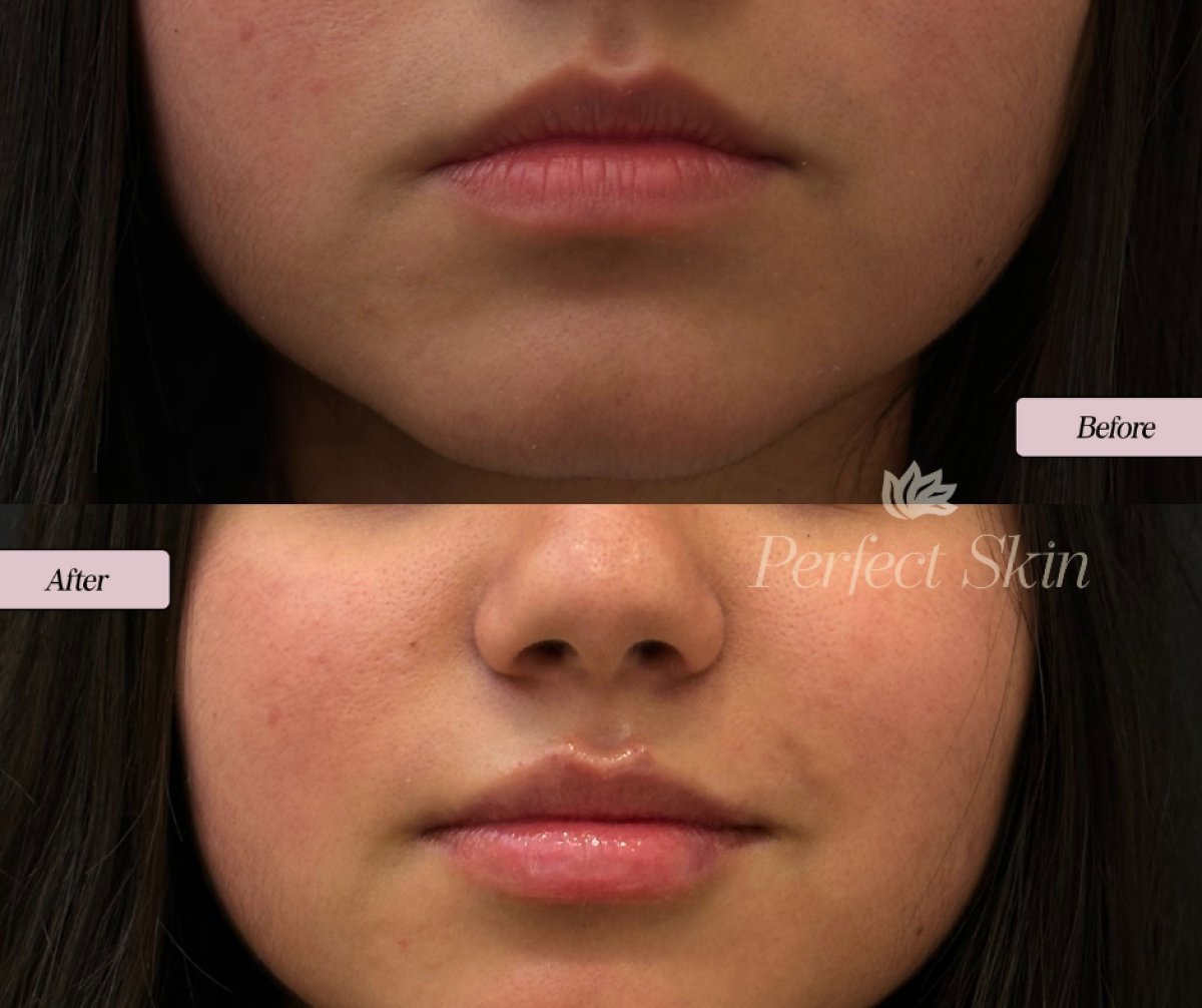 Résultat avant/après injections d'acide hyaluronique chez Perfect Skin – lèvres repulpées