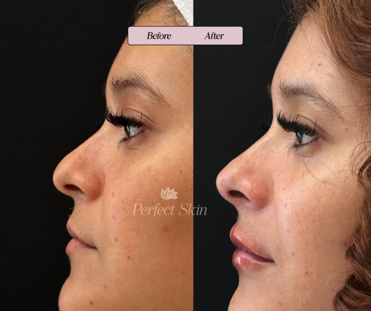Before and after hyaluronic acid fillers result for nose reshaping at Perfect Skin clinic