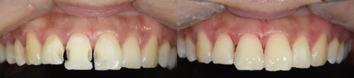 Before and after inlay/onlay dental treatment results – improved front teeth appearance