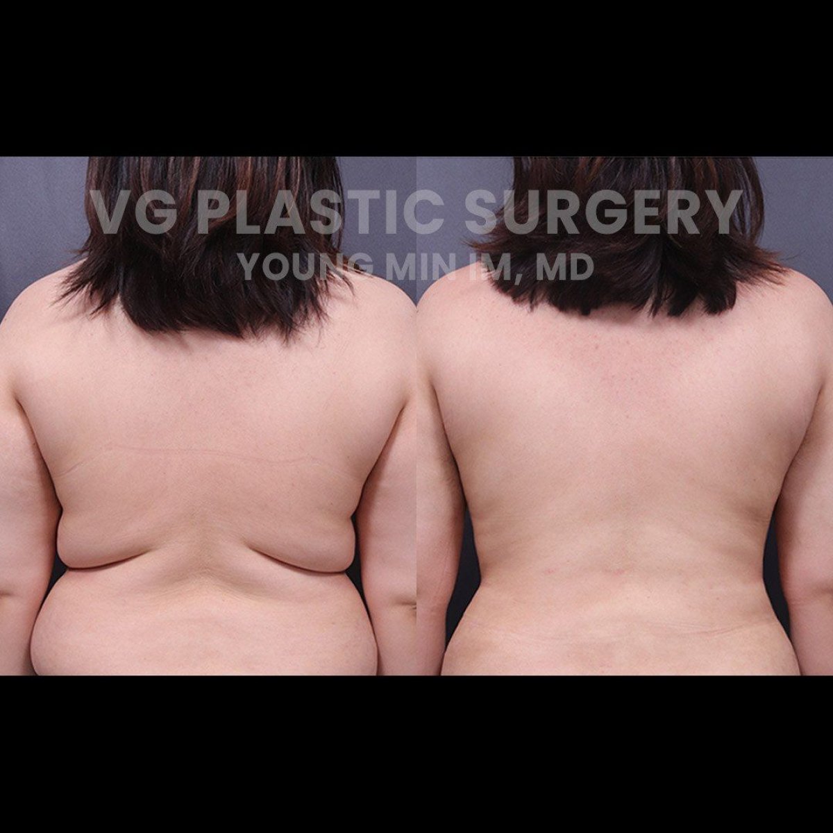 Результати до і після Vaser ліпосакції у VG Plastic Surgery, помітне покращення спини