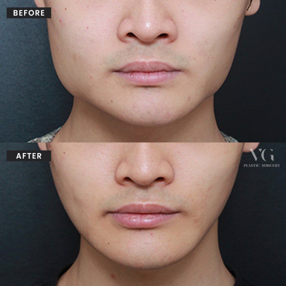 Результаты до и после коррекции челюсти в VG Plastic Surgery – улучшенный контур