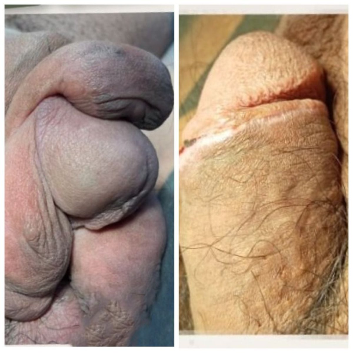 Before and after penile paraffinoma surgery results at Menness Wellness Clinic, improved contour