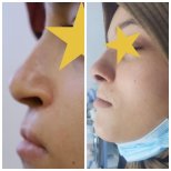 Fotos vor und nach Rhinoplastik (Nasenkorrektur) durch Dr. Walid Eljabu