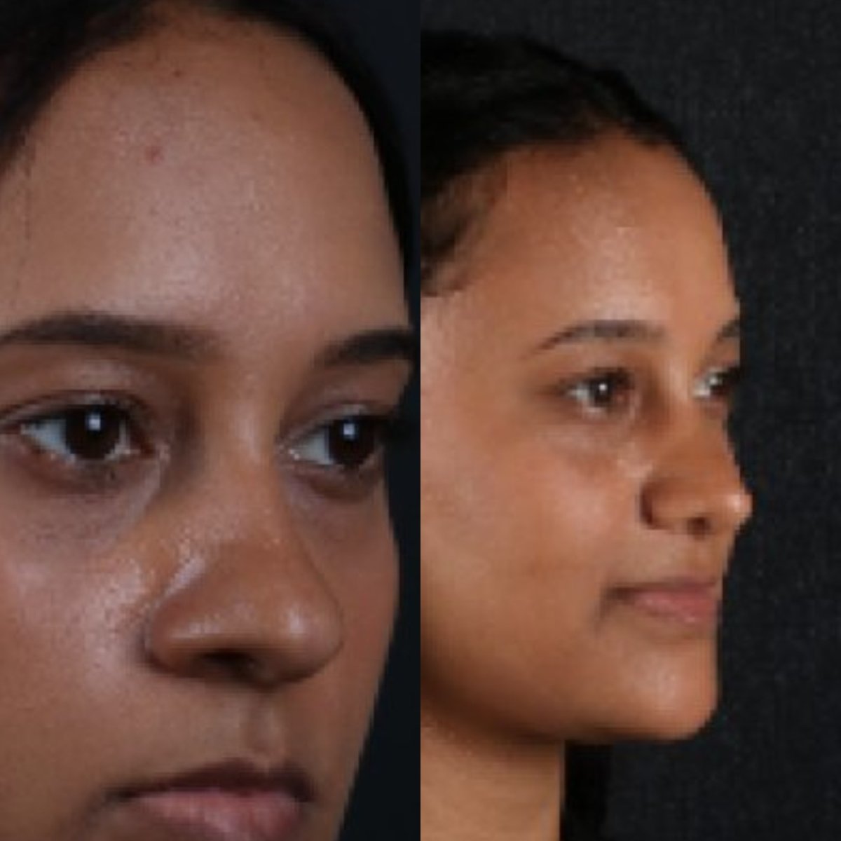 Resultados de rinoplastia antes y después, remodelación nasal para armonía facial