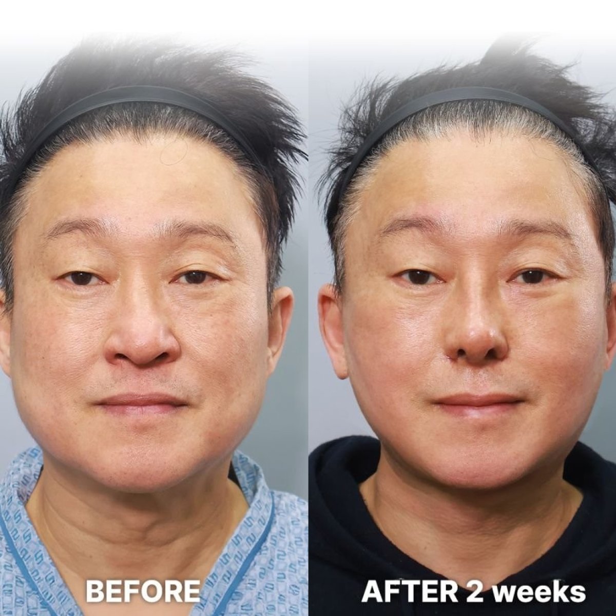 Before and after endoscopic facelift results at Returning Plastic Surgery, visible facial rejuvenation