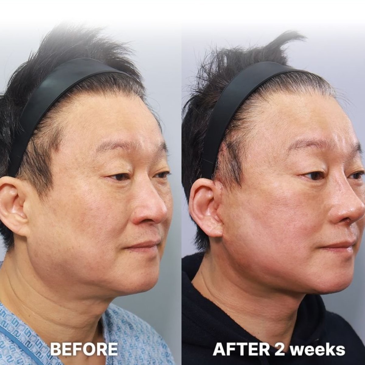 Результаты эндоскопической подтяжки лица в Returning Plastic Surgery, видимый лифтинг