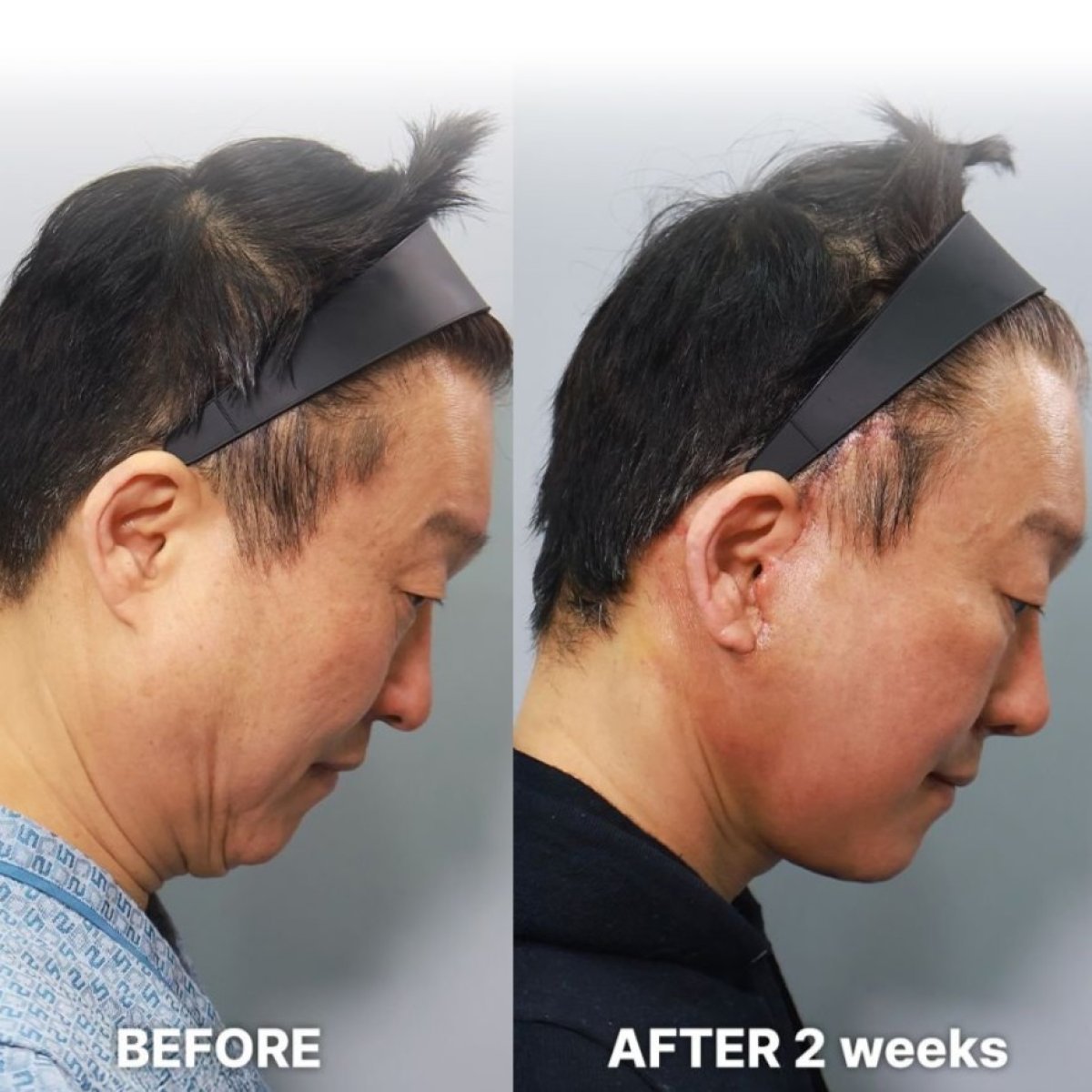 Vorher-nachher-Ergebnis Endoskopisches Facelifting bei Returning Plastic Surgery, sichtbarer Halslift