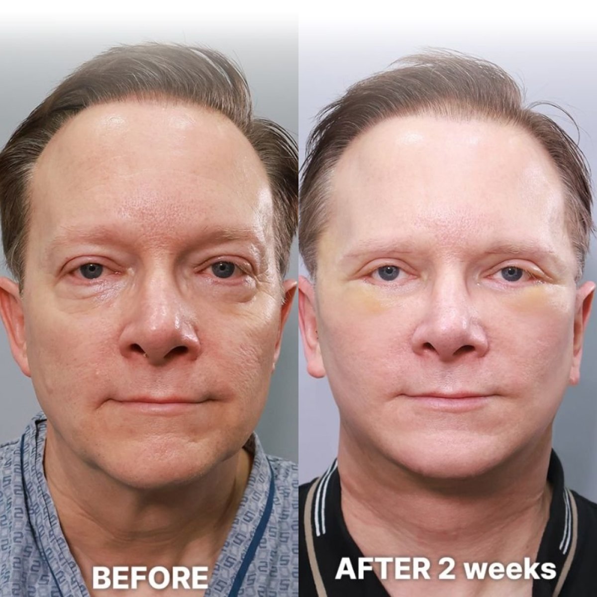 Endoscopic facelift before and after results at Returning Plastic Surgery, visible facial rejuvenation