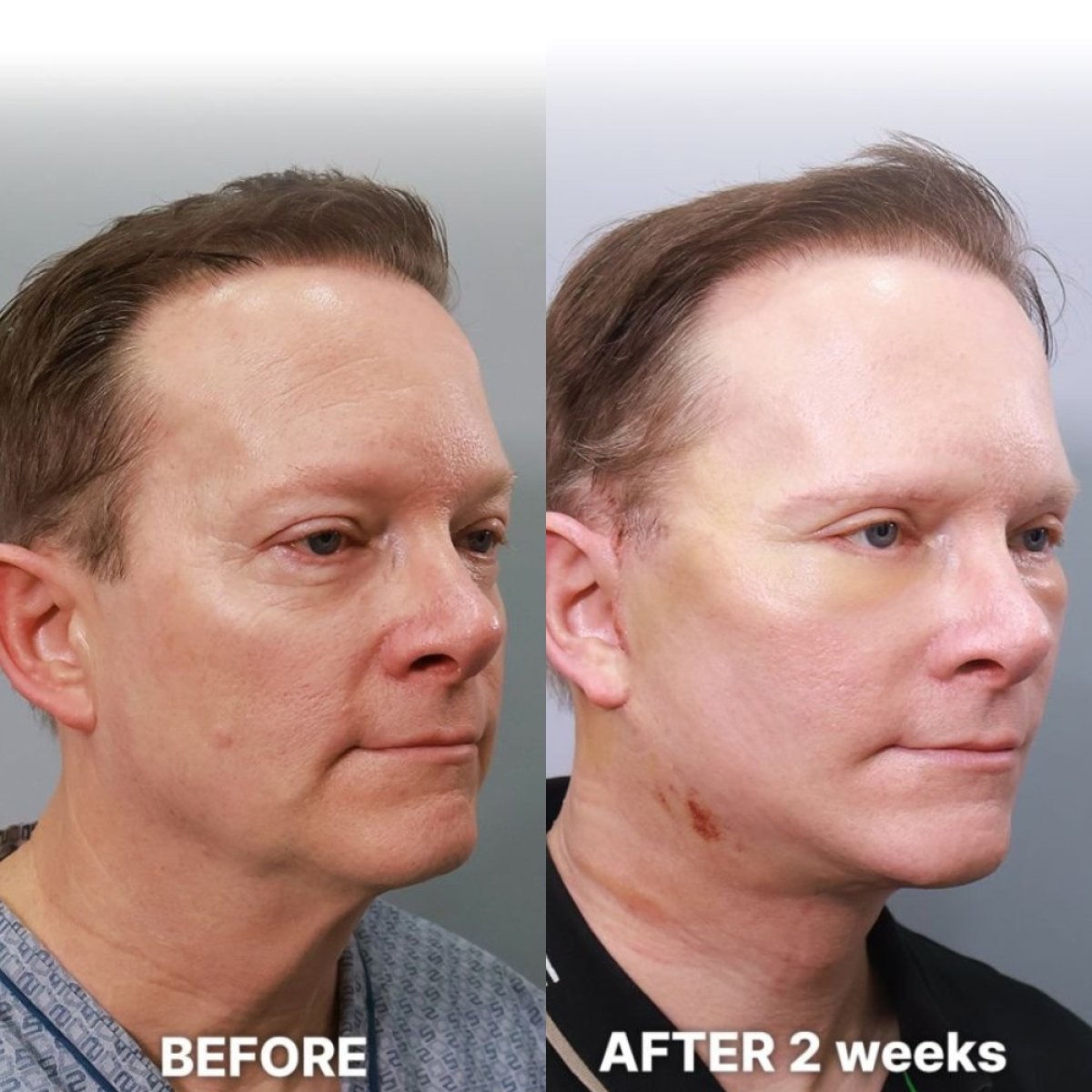 Before and after endoscopic facelift results at Returning Plastic Surgery, visible facial lift