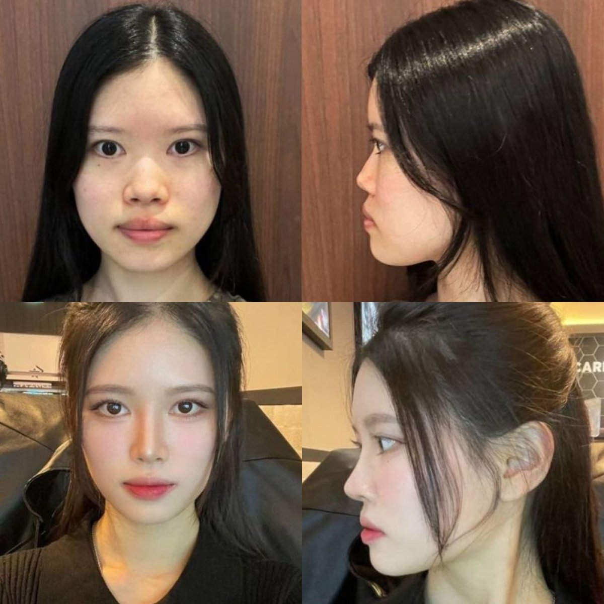 نتائج قبل وبعد تجميل الأنف الآسيوي في VG Plastic Surgery، تحسين شكل الأنف
