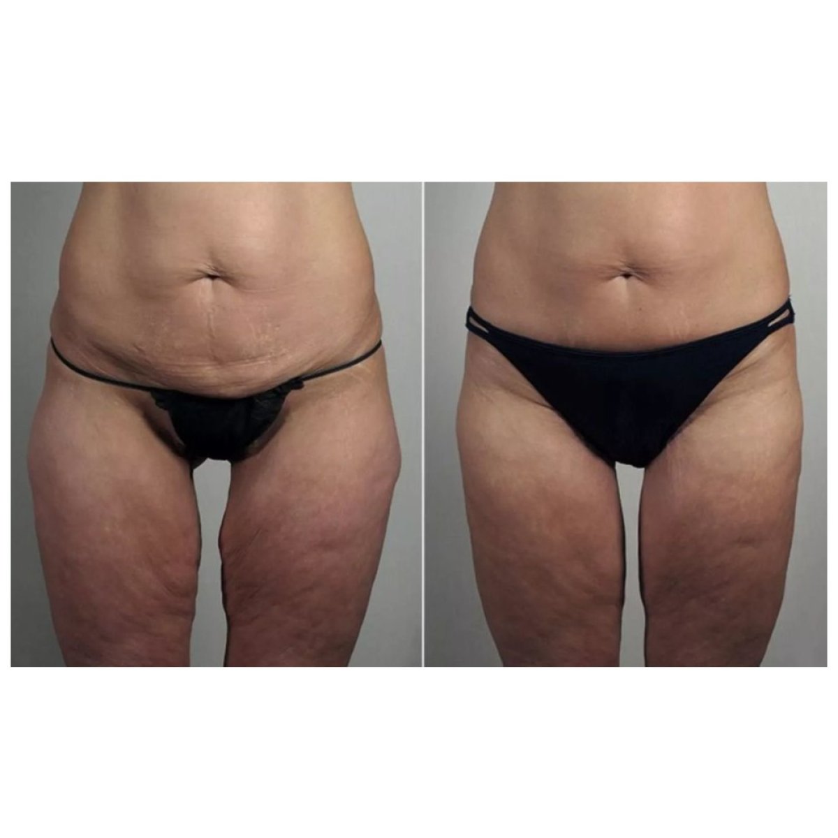 Resultados antes y después de lifting de muslos en Dr. Alexandro Aguilera - Plastic Surgery, mejor contorno