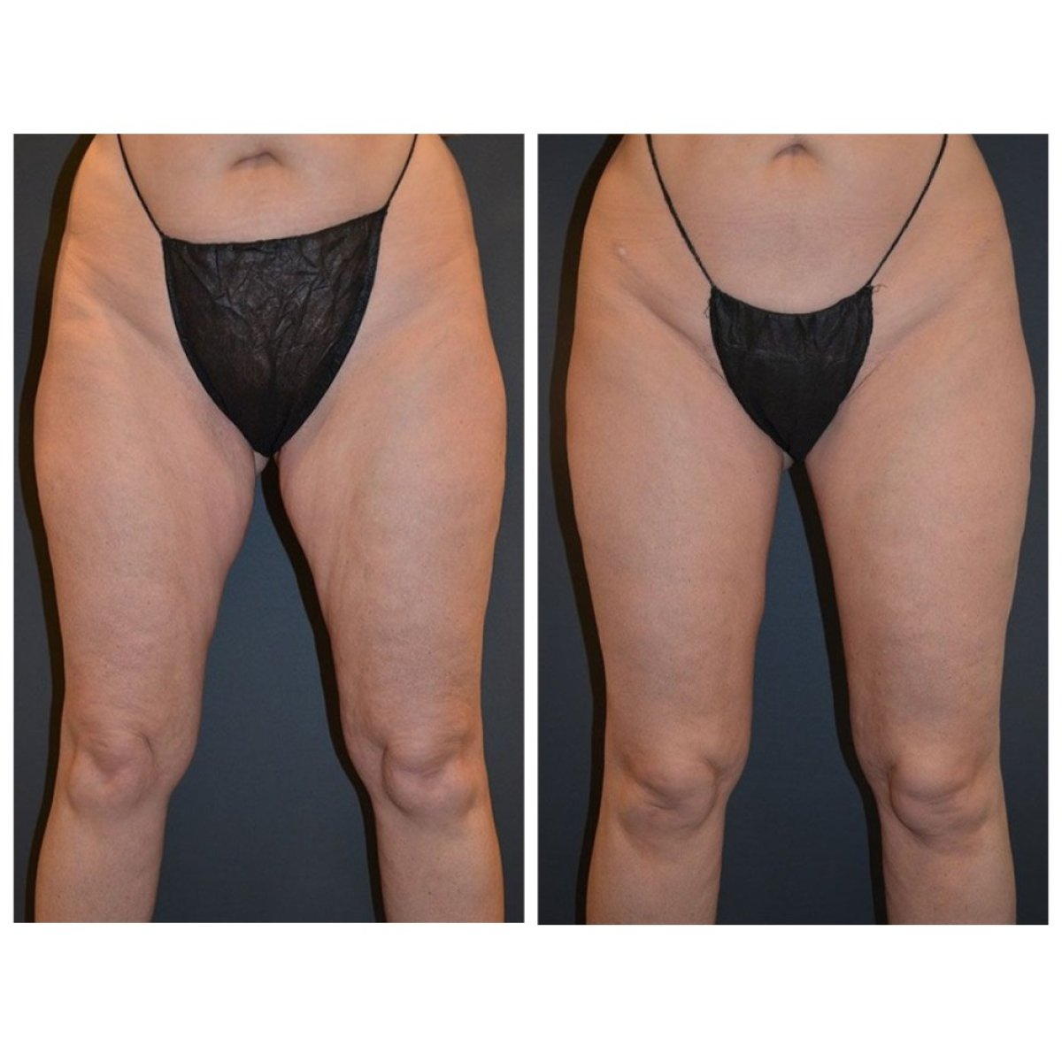Resultados de lifting de muslos antes y después en Dr. Alexandro Aguilera - Plastic Surgery