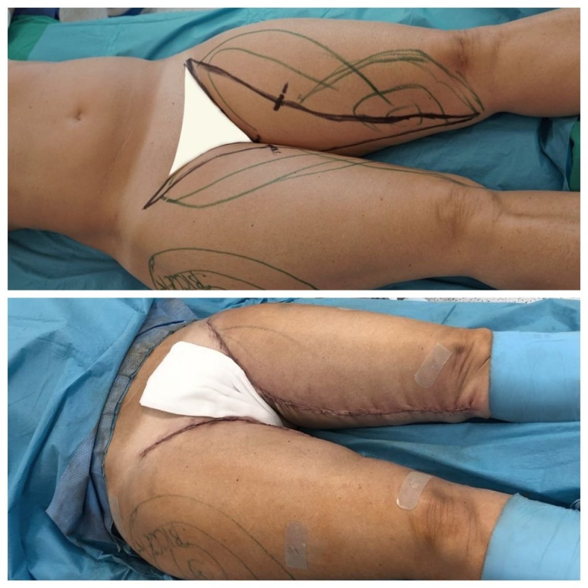 نتائج شد الفخذين قبل وبعد في Dr. Alexandro Aguilera - Plastic Surgery، تحسين الشكل