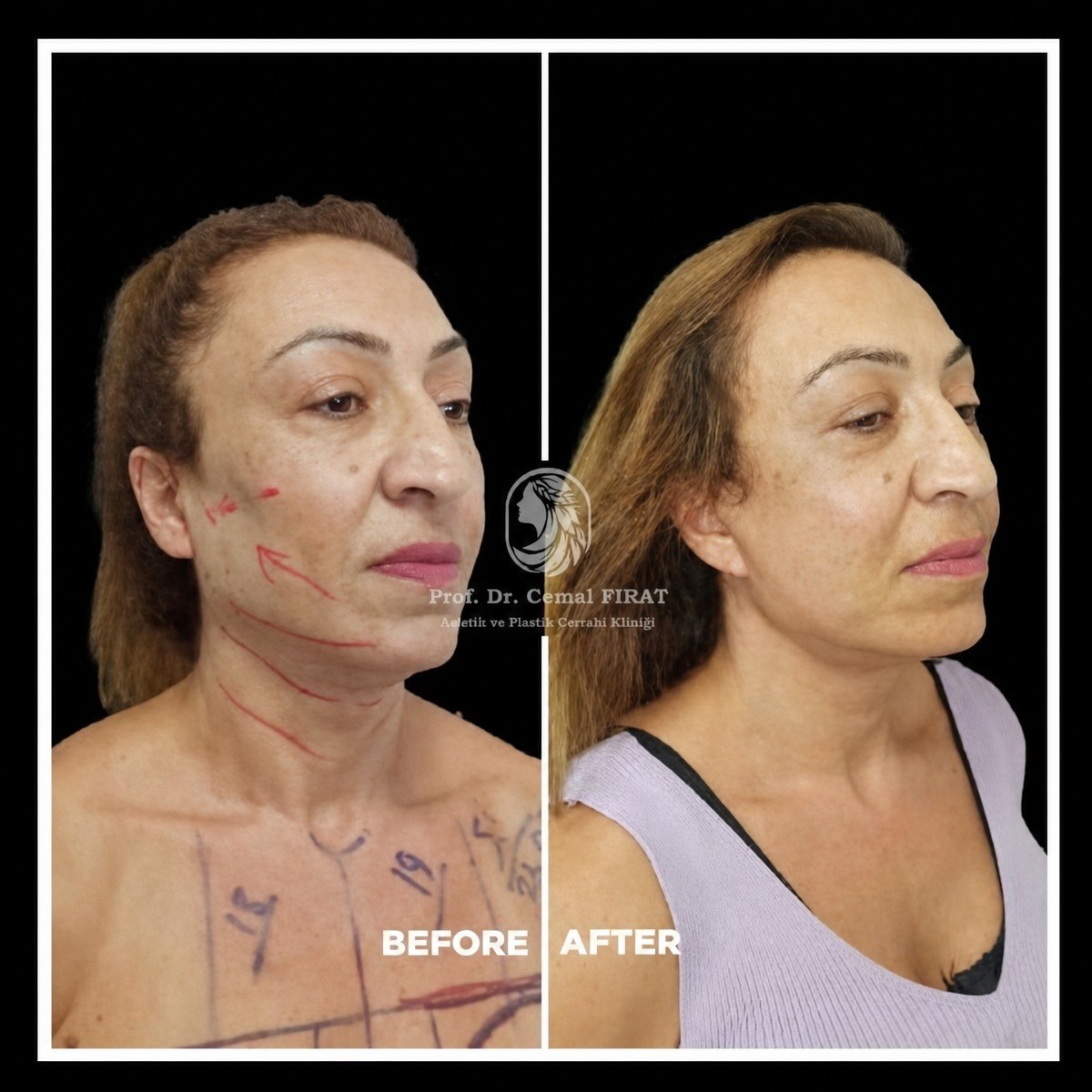 Resultados de lifting de cuello antes y después en Medical Park Antalya Hospital Complex, mejora visible