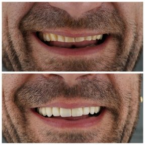 Smile Makeover with Zirconia Crowns & 3D Digital Smile Design - photo 4