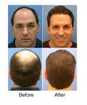 صور قبل وبعد زراعة الشعر للدكتور Dr Phatcharasak Kraisornphongsakul Md
