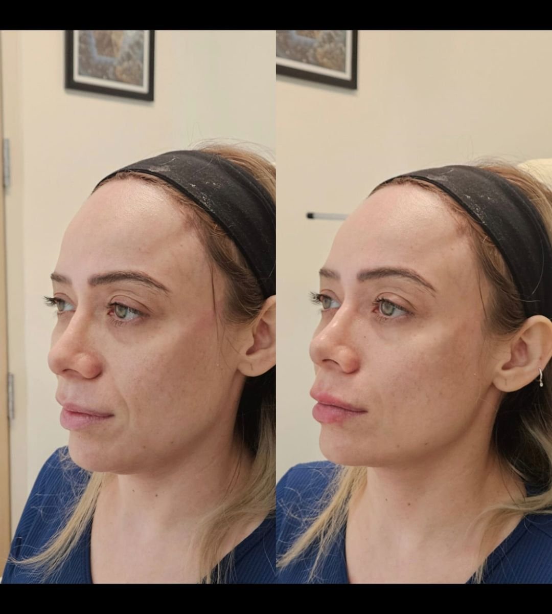 نتيجة قبل وبعد حقن الفيلر في عيادة Dr. Lavalle، زيادة حجم الوجه