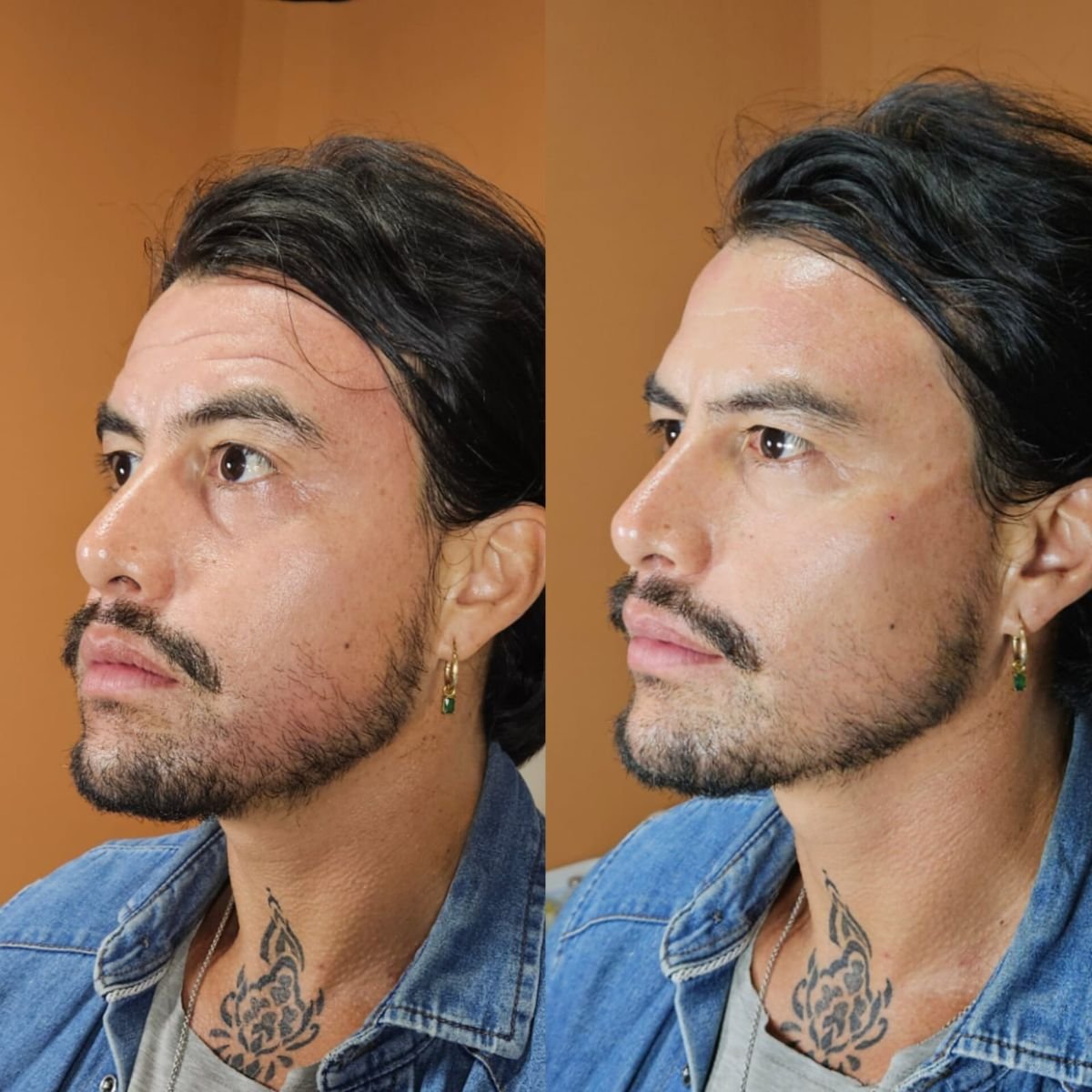 Before and after fillers injection result at Dr. Lavalle's Private Practice, enhanced facial contour