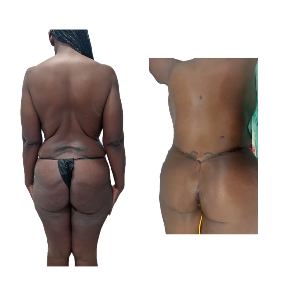 Before and after post-bariatric plastic surgery results at Hospital de la Familia, body contour
