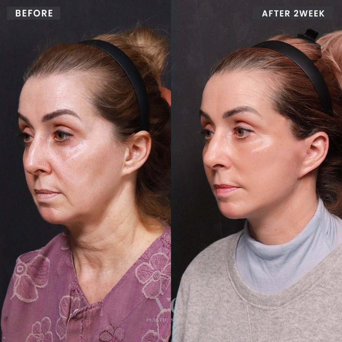Результаты подтяжки лба до и после в VG Plastic Surgery, заметно гладкий лоб и брови