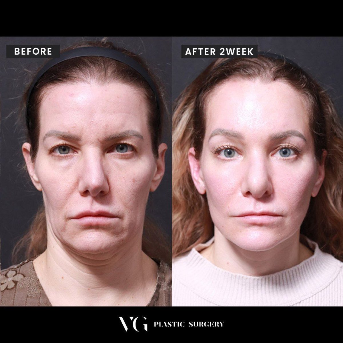 Before and after forehead lift results at VG Plastic Surgery, visible brow and facial rejuvenation