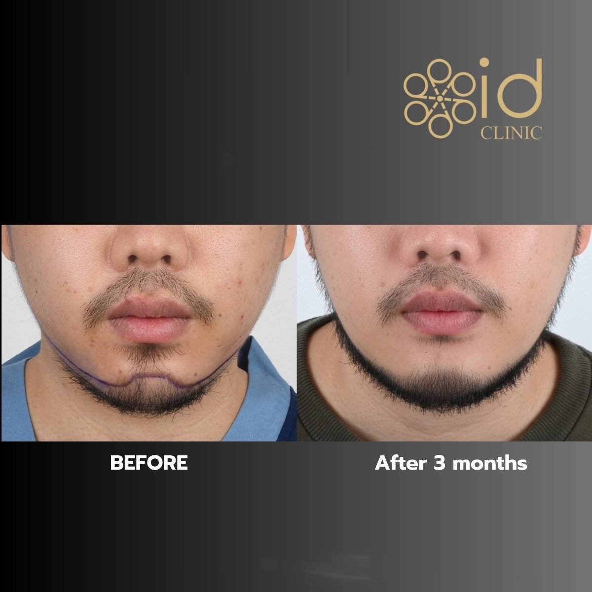 Chin liposuction before and after results at ID Clinic Bangkok, improved jawline after 3 months
