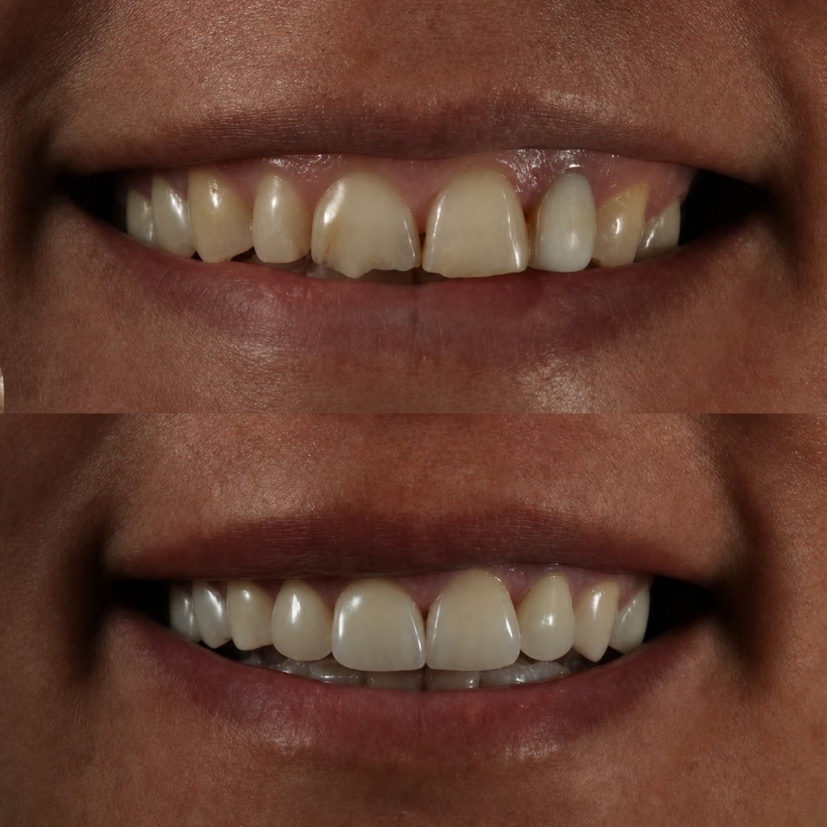 نتائج قبل وبعد تركيب تيجان الزركونيا في Grand Dental Hospital & Laboratory، ترميم الابتسامة