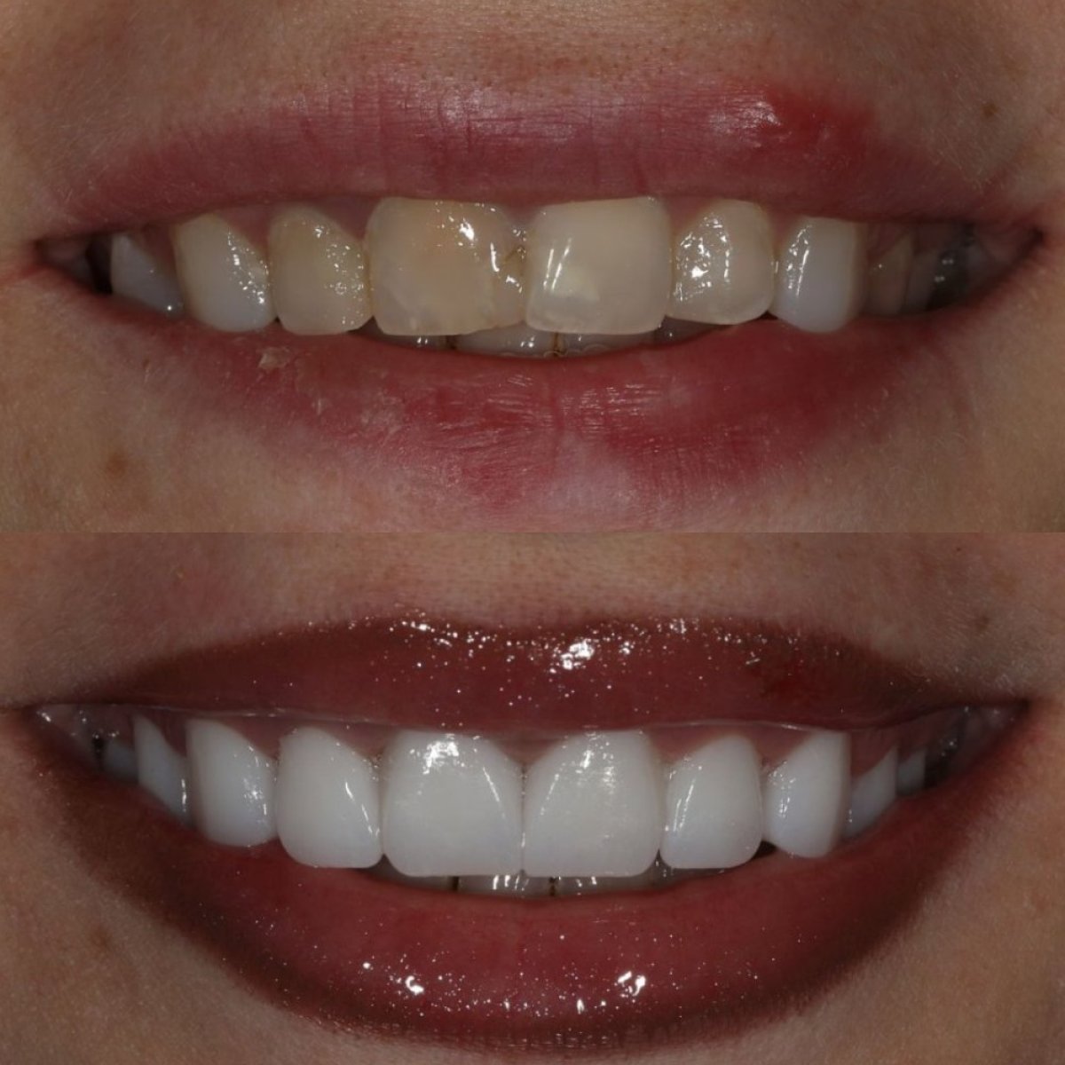 نتائج قبل وبعد تركيب تيجان الزركونيا في Grand Dental Hospital & Laboratory، تجميل الابتسامة