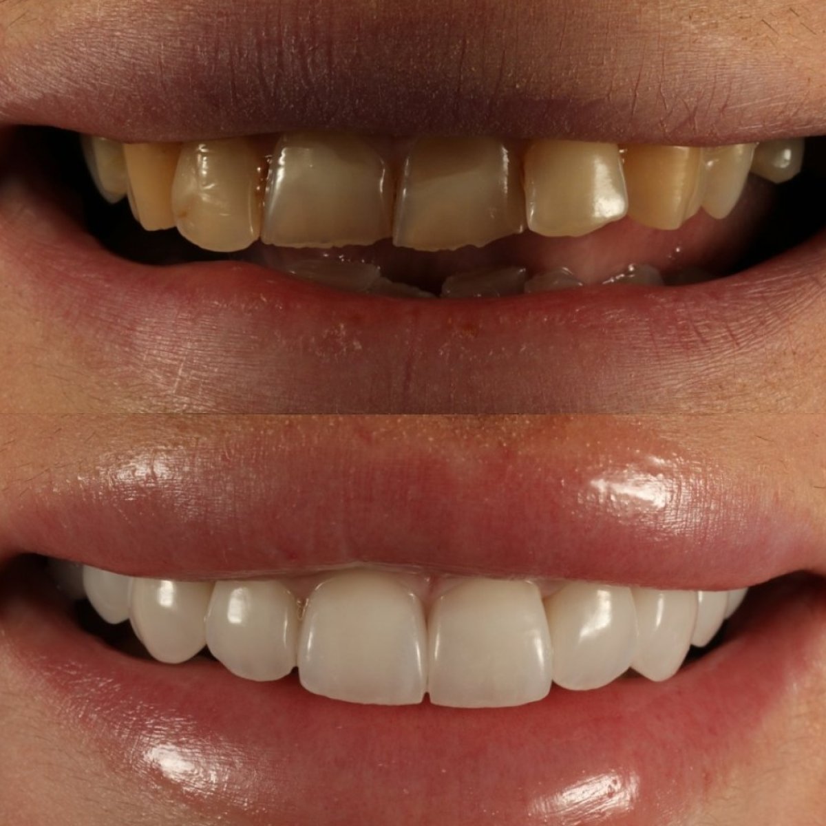 До и после виниров Hollywood Smile в Grand Dental Hospital & Laboratory, результат улыбки