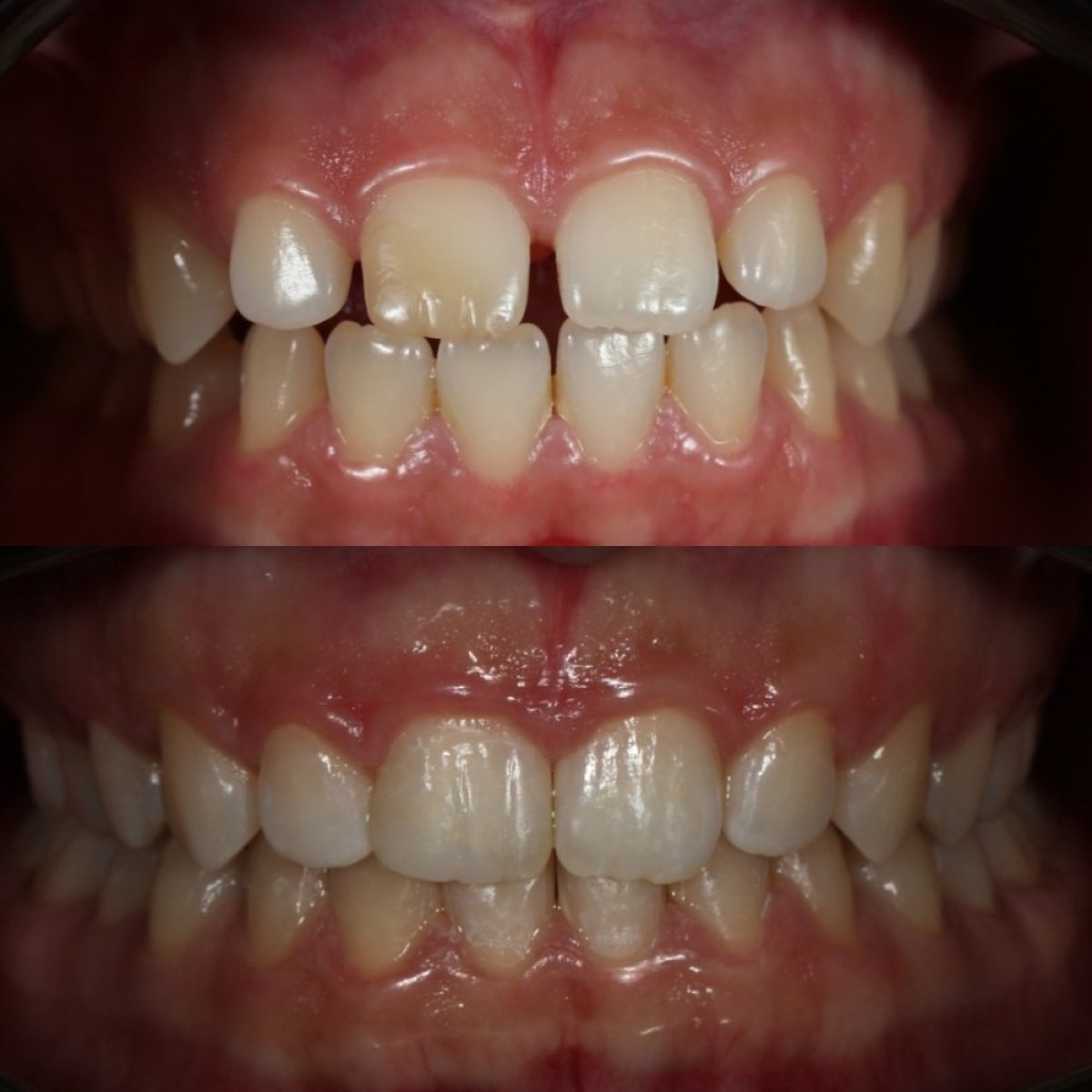 Résultat avant et après aligneurs transparents au Grand Dental Hospital & Laboratory, alignement