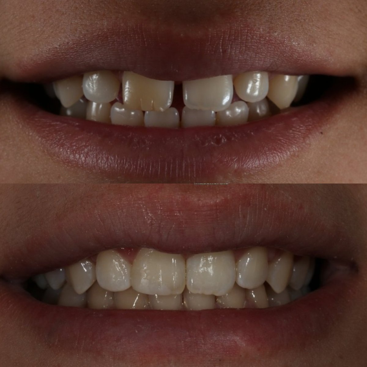 نتيجة قبل وبعد التقويم الشفاف في Grand Dental Hospital & Laboratory، أسنان مستقيمة