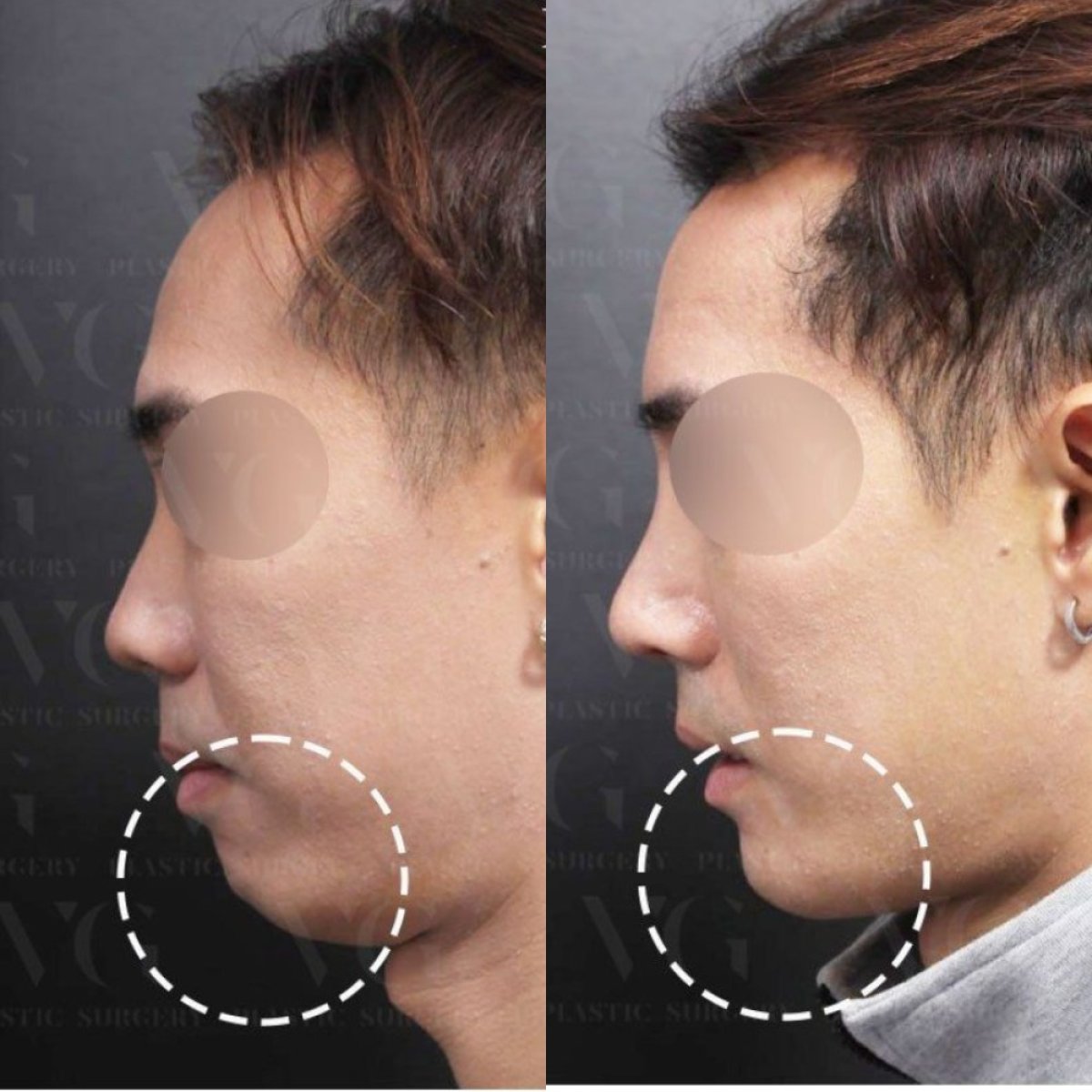 نتيجة قبل وبعد جراحة الذقن المنزلقة في VG Plastic Surgery، تحسين شكل الذقن
