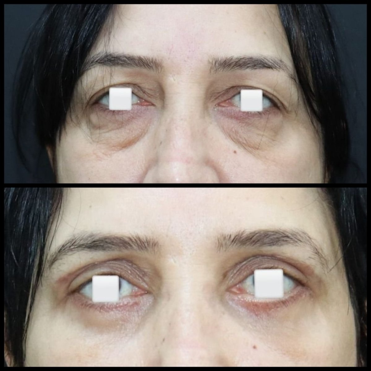 Resultados de blefaroplastia antes y después en Assoc.Prof.Dr.Cemal Kara / Medical Park İzmir Hospital