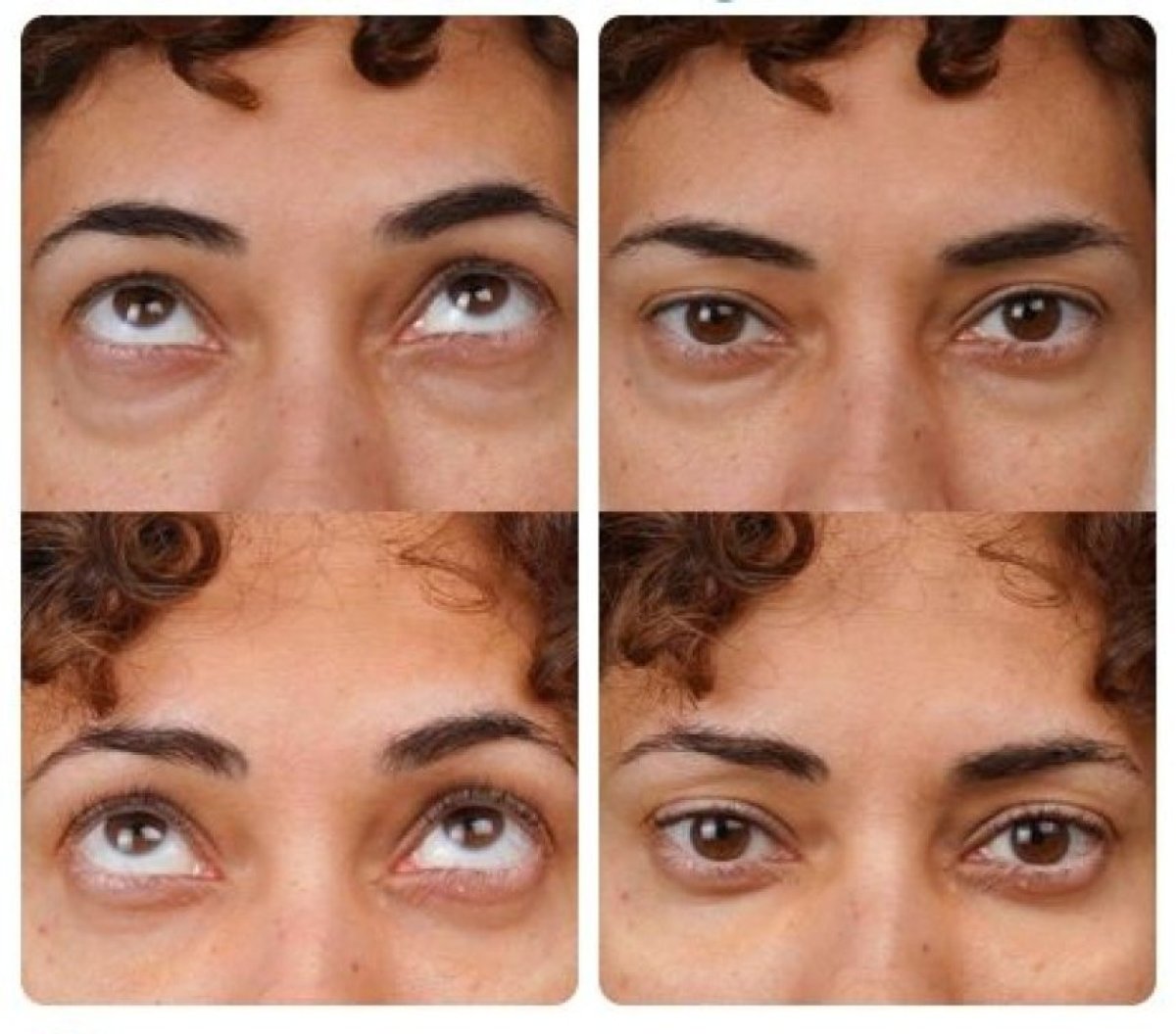 Before and after blepharoplasty results at Yurchenko Plastic Surgery Team, eyelid correction