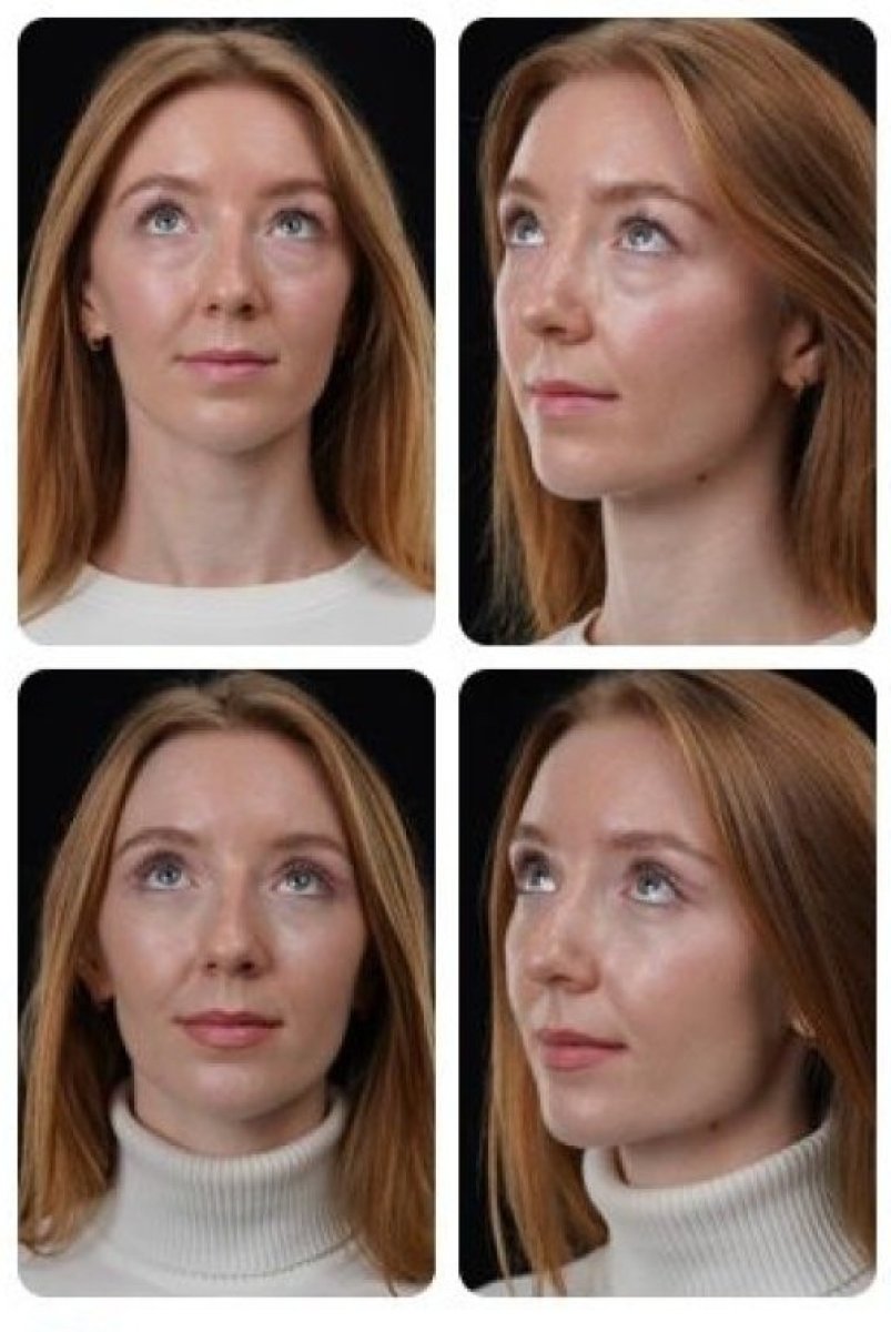نتائج رأب الجفن قبل وبعد في Yurchenko Plastic Surgery Team، تصحيح الجفون
