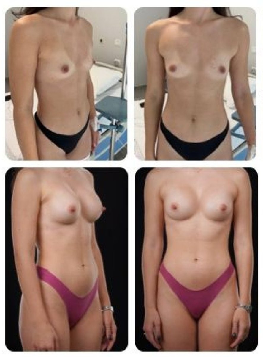 Before and after breast augmentation results at Yurchenko Plastic Surgery Team Kyiv, natural look