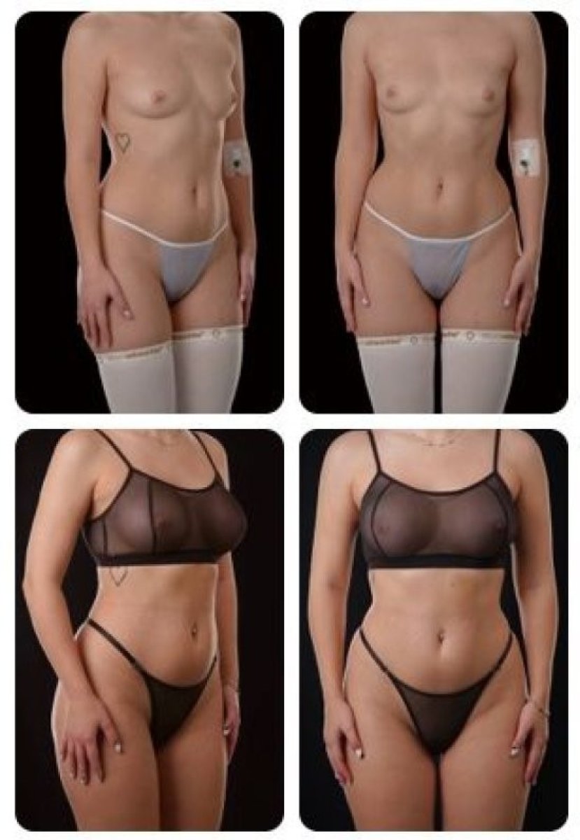 Результаты до и после увеличения груди в Yurchenko Plastic Surgery Team Киев