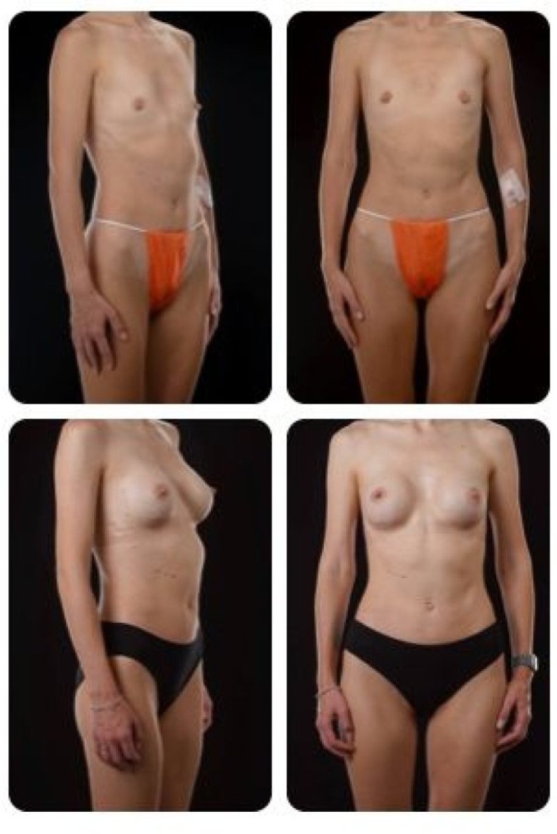 Результати до і після збільшення грудей у клініці Yurchenko Plastic Surgery Team Kyiv